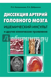 Диссекция артерий головного мозга: ишемический инсульт и другие клинические проявления