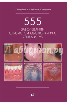 555 заболеваний слизистой оболочки рта, языка и губ