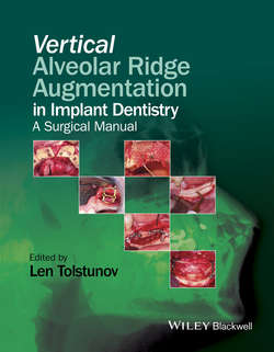 Vertical Alveolar Ridge Augmentation in Implant Dentistry. A Surgical Manual