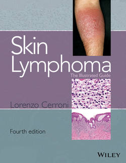 Skin Lymphoma. The Illustrated Guide