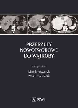 Przerzuty nowotworowe do wątroby