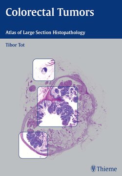 Colorectal Tumors