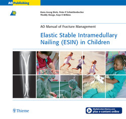 Elastic Stable Intramedullary Nailing (ESIN) in Children