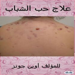 علاج حب الشباب